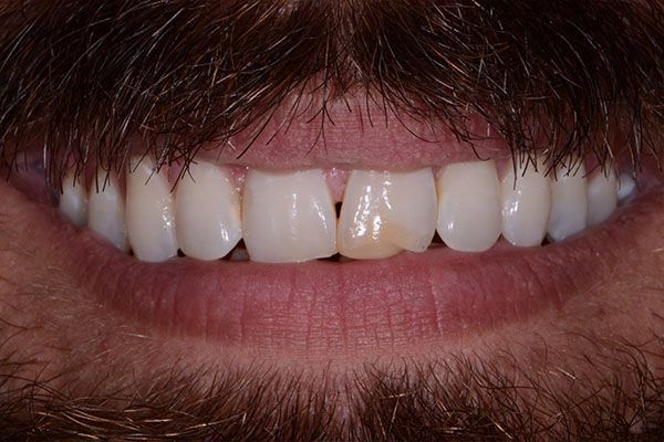 A close up of a man 's teeth with a beard. Composite Bonding