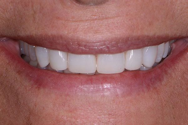 A close up of a woman 's smile with white teeth. Composite Veneers