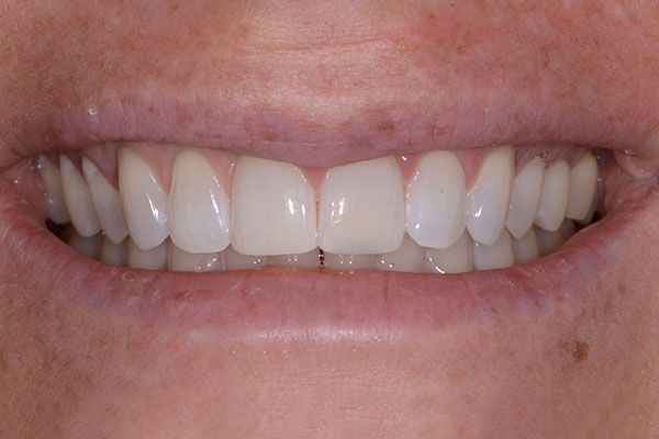 A close up of a person 's smile with white teeth. Composite Veneers