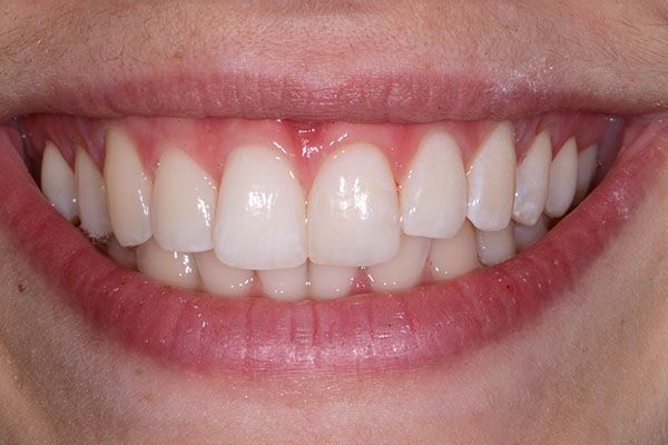 A close up of a person 's smile with white teeth and red lips. Composite Veneers