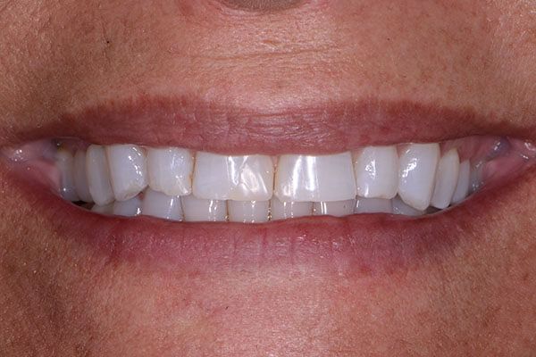 A close up of a woman 's smile with white teeth. Composite Veneers