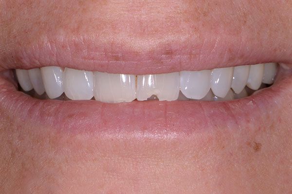 A close up of a person 's teeth with a missing tooth. Composite Veneers