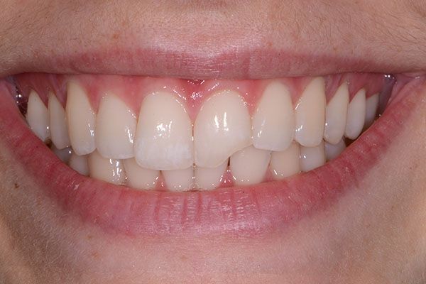 A close up of a person 's smile with white teeth. Composite Veneers