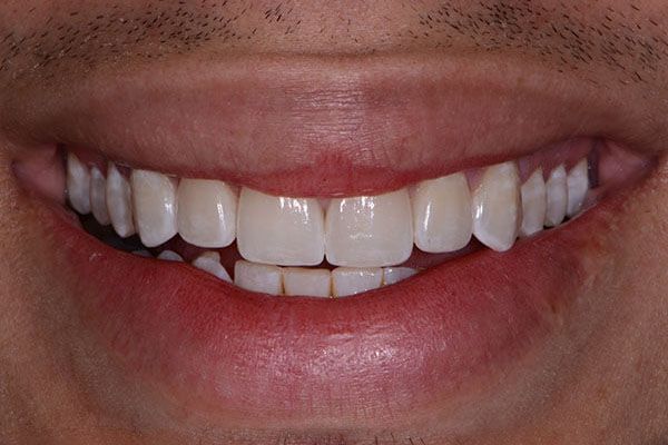 A close up of a man 's smile with white teeth. Porcelain Veneers
