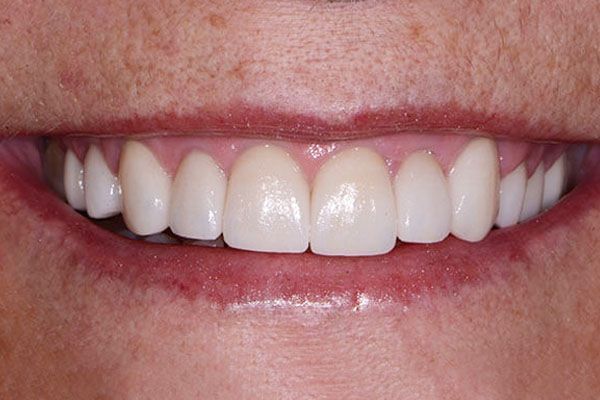 A close up of a woman 's smile with white teeth. Porcelain Veneers