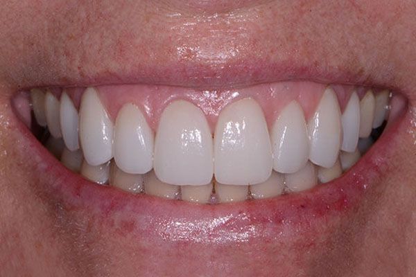 A close up of a woman 's smile with white teeth. Veneers