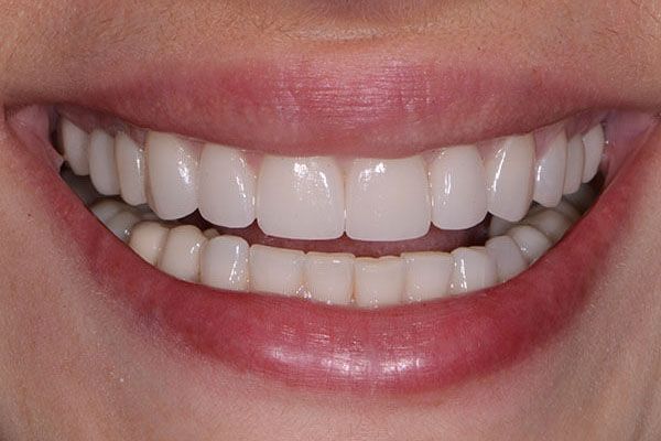 A close up of a woman 's smile with white teeth. Veneers