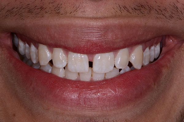 A close up of a man 's smile with missing teeth. Porcelain Veneers