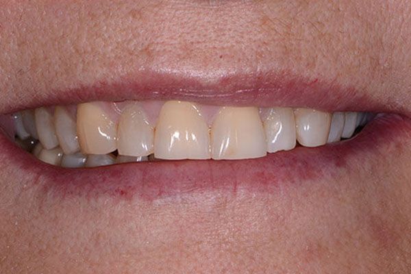 A close up of a person 's teeth and lips. Porcelain Veneers