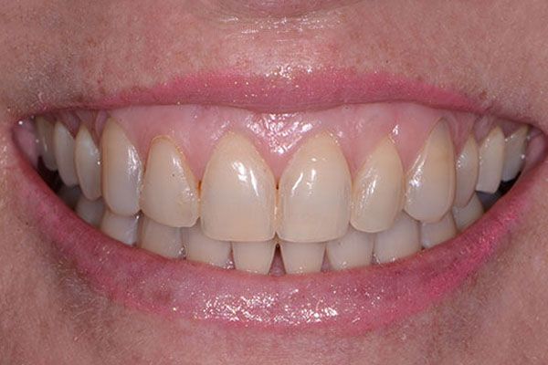 A close up of a person 's teeth with a smile on their face. Veneers
