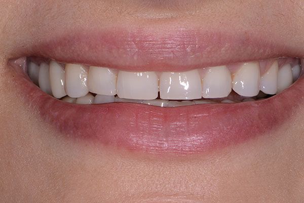 A close up of a woman 's smile with white teeth. Porcelain Veneers