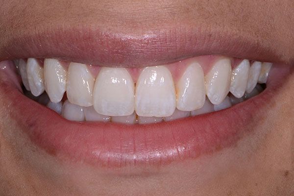 A close up of a woman 's smile with white teeth. Single Crowns