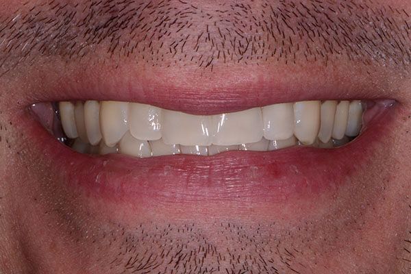 A close up of a man 's mouth with a beard and white teeth. Porcelain Veneers