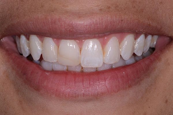 A close up of a woman 's smile with white teeth. Porcelain Veneers