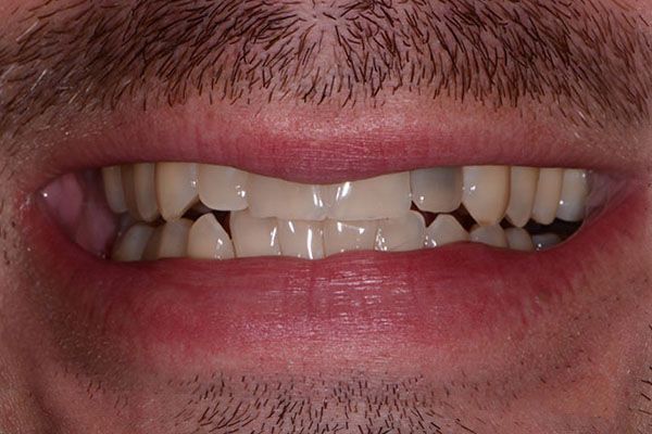 A close up of a man 's mouth with a beard and missing teeth. Porcelain Veneers