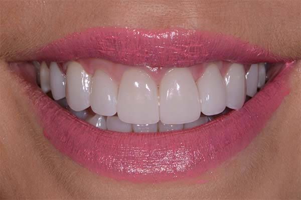 A close up of a woman 's smile with white teeth and pink lips. Veneers