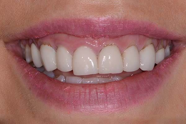 A close up of a woman 's mouth with white teeth and pink lips. Veneers