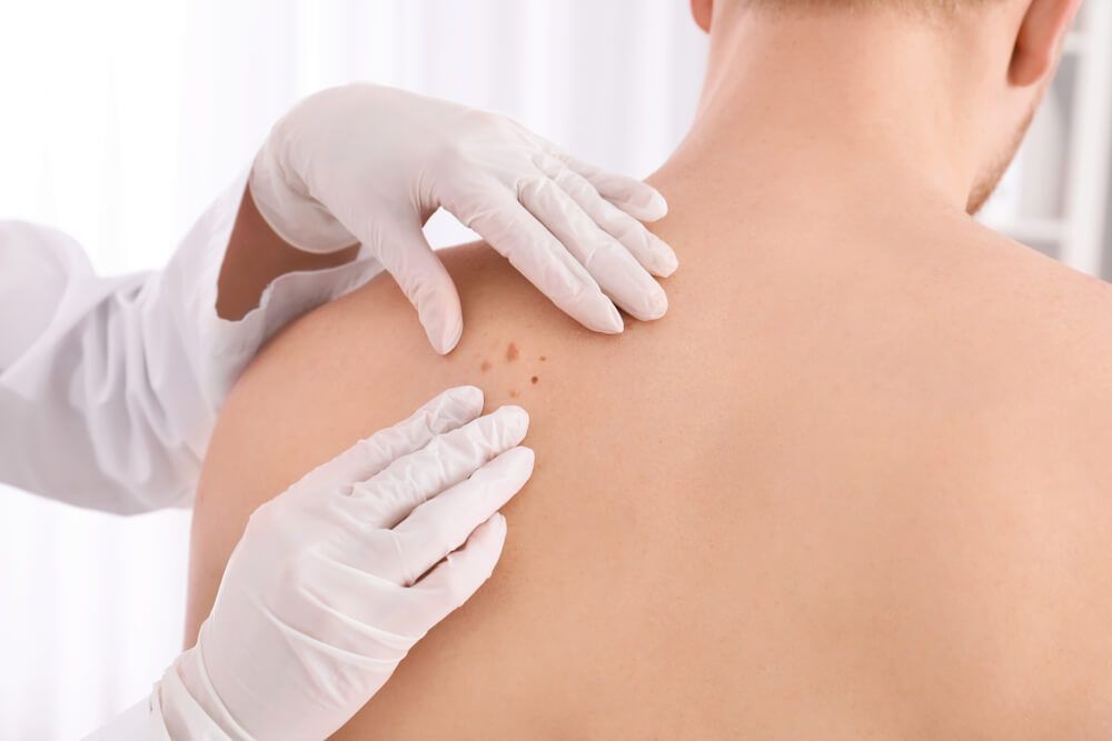 A Physician wearing white gloves assessing the moles on a person's back — Tuncurry Medical Centre In Tuncurry, NSW