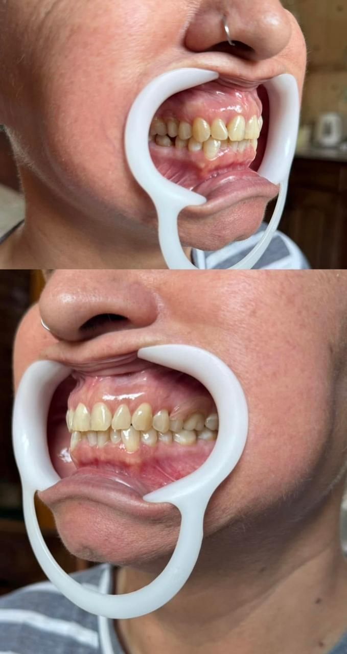 Dos fotografías comparativas de dientes mantenidos abiertos con un retractor, que muestran su estado.