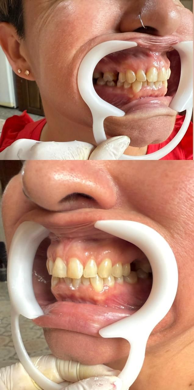 Dos vistas una al lado de la otra de los dientes en la boca de una persona con un retractor de mejillas.