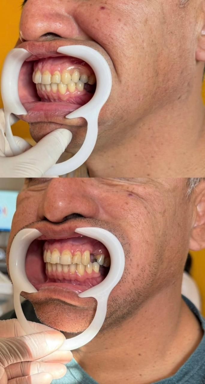 Dos vistas de los dientes; un retractor bucal en uso, dientes antes y después del tratamiento.
