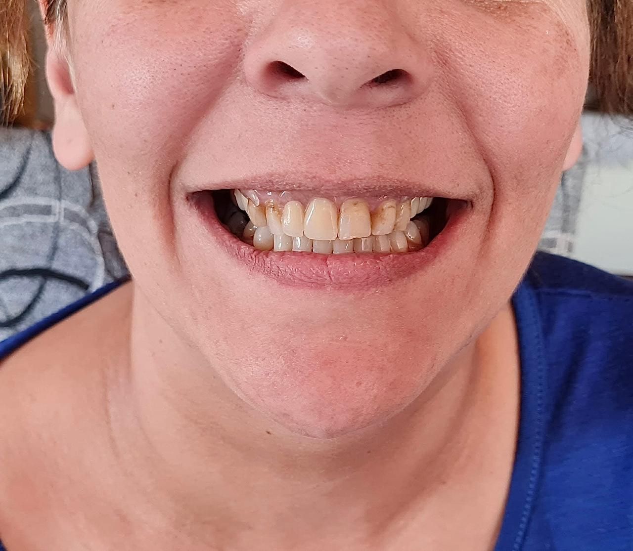 Primer plano de una persona sonriendo, dejando ver sus dientes manchados. Lleva una camisa azul y el fondo está desenfocado.