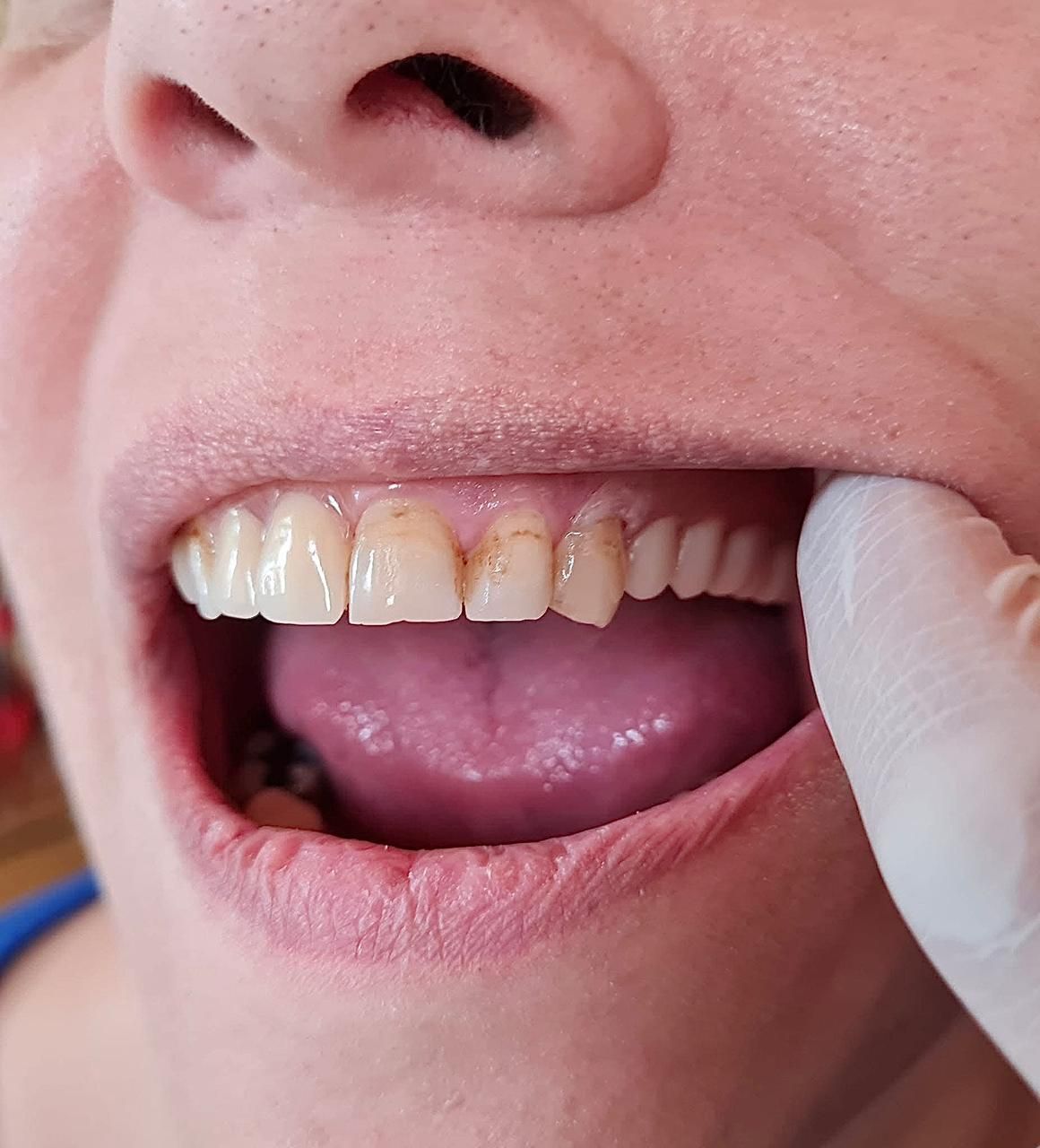 Boca abierta, mostrando dientes con manchas marrones. El dedo tira del labio hacia atrás. Lengua y labios rosados.