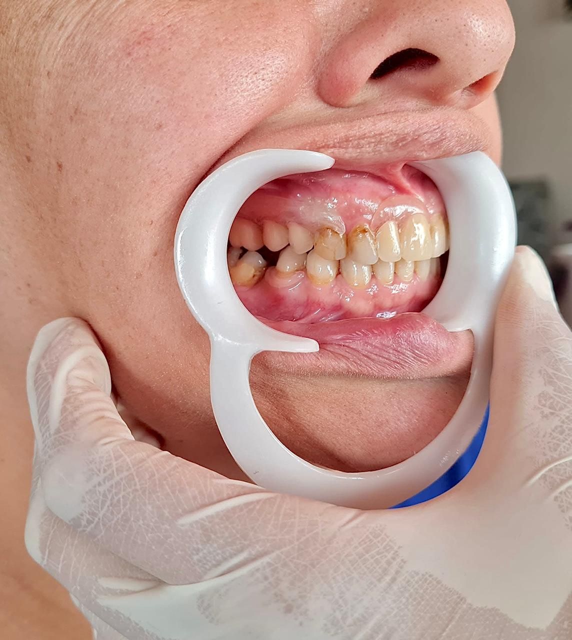 Boca abierta con un retractor, mostrando dientes con cierta decoloración. Se ve una mano enguantada.