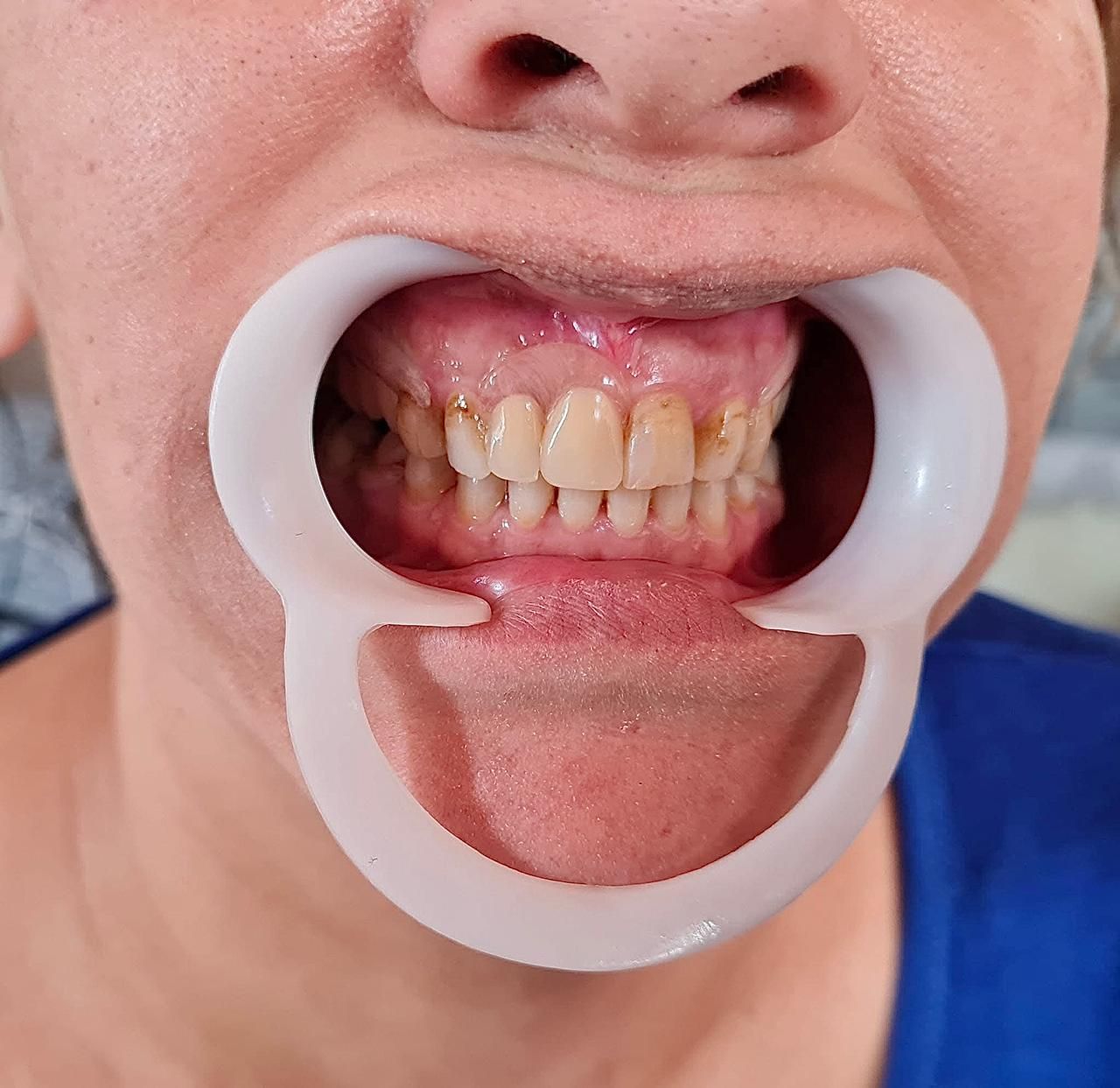 Persona con un retractor bucal, que deja al descubierto dientes y encías.