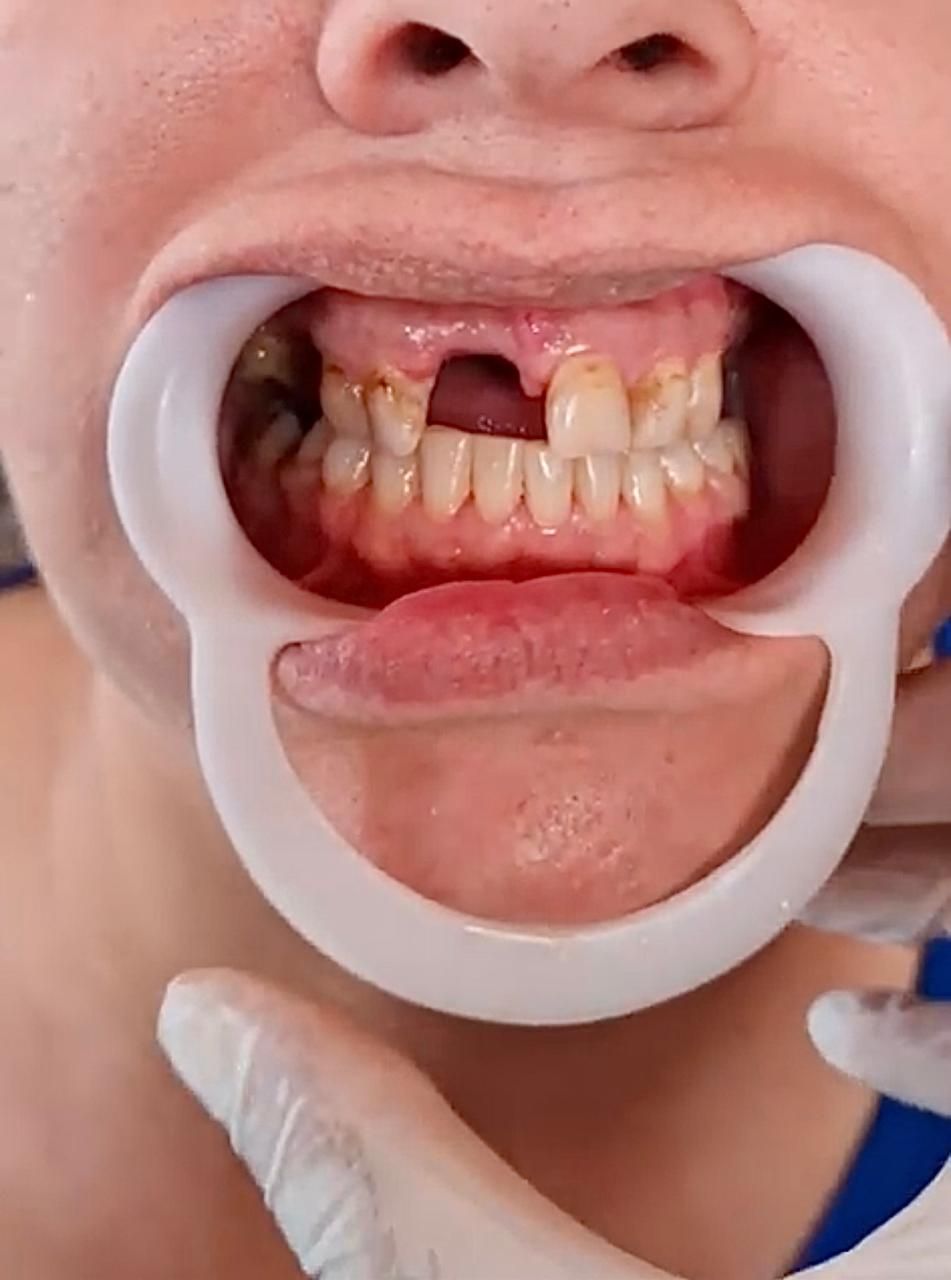 Boca con un diente faltante, mantenida abierta con un retractor. Los dientes parecen cariados.
