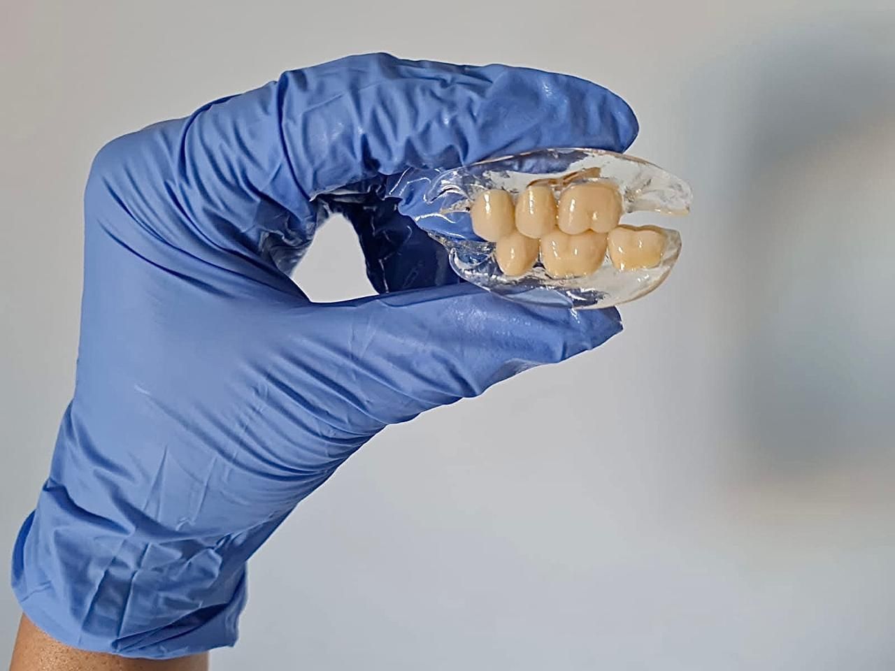 Mano enguantada sosteniendo un retenedor dental transparente con un juego de dientes artificiales.