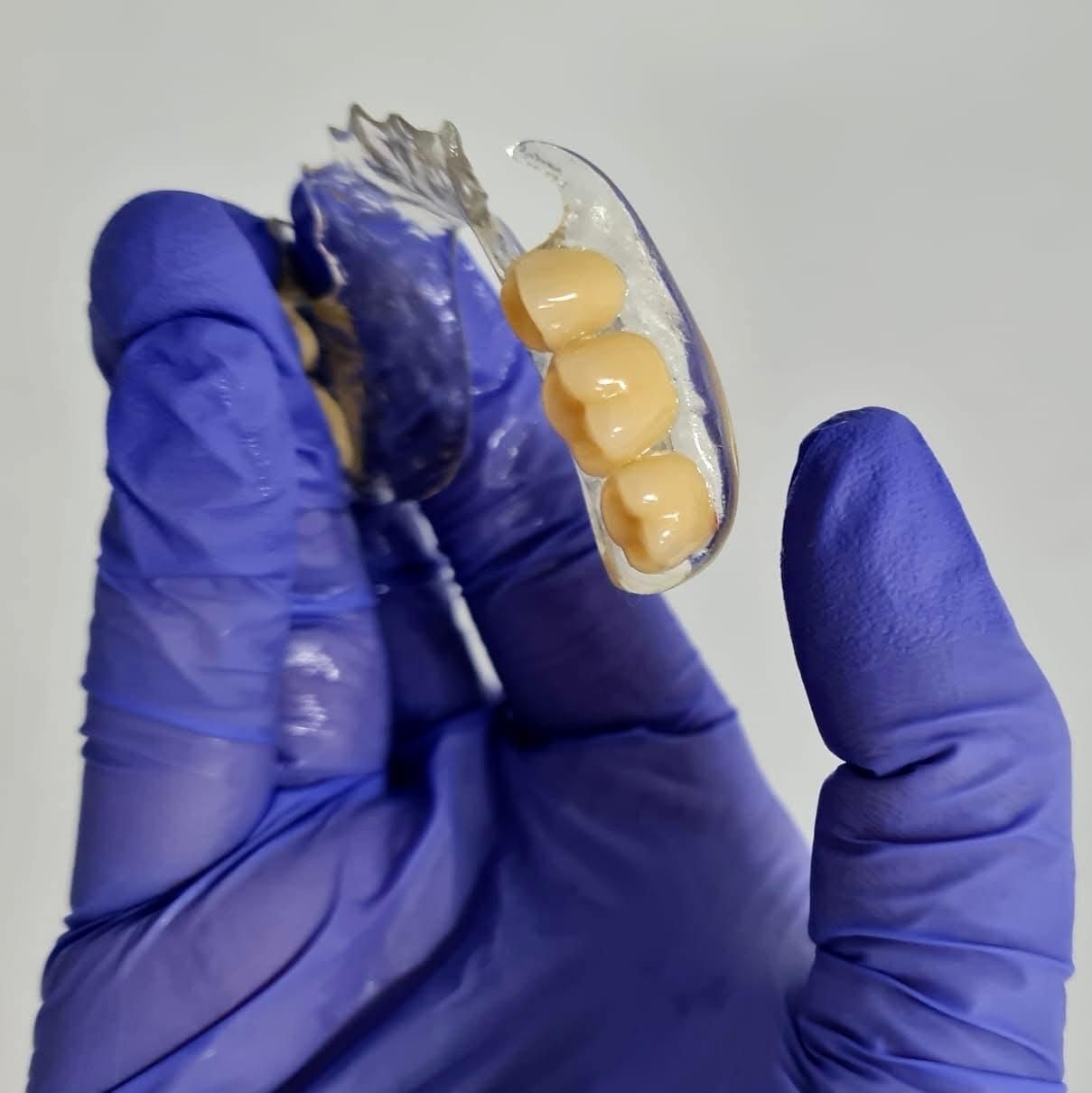 Mano con guante azul sosteniendo una prótesis parcial de tres dientes.