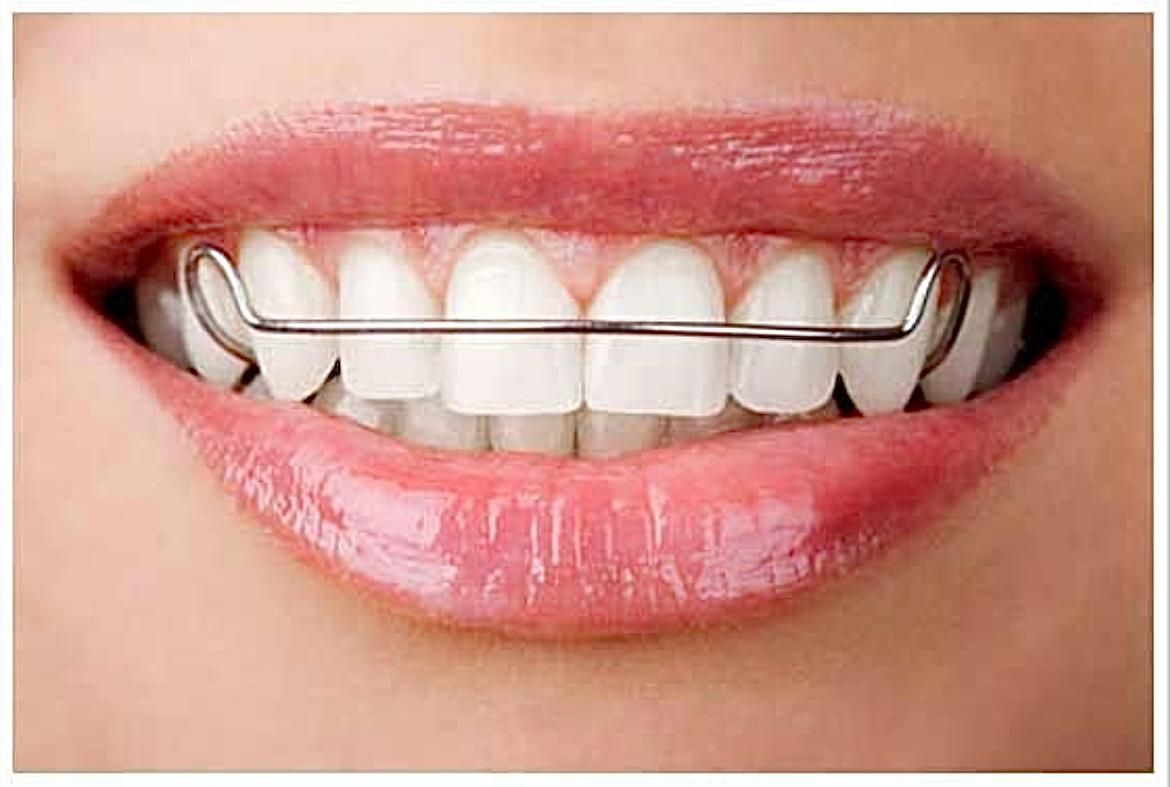 Primer plano de la boca sonriente de una persona. Se aprecia un aparato de ortodoncia en los dientes superiores y los labios brillantes.