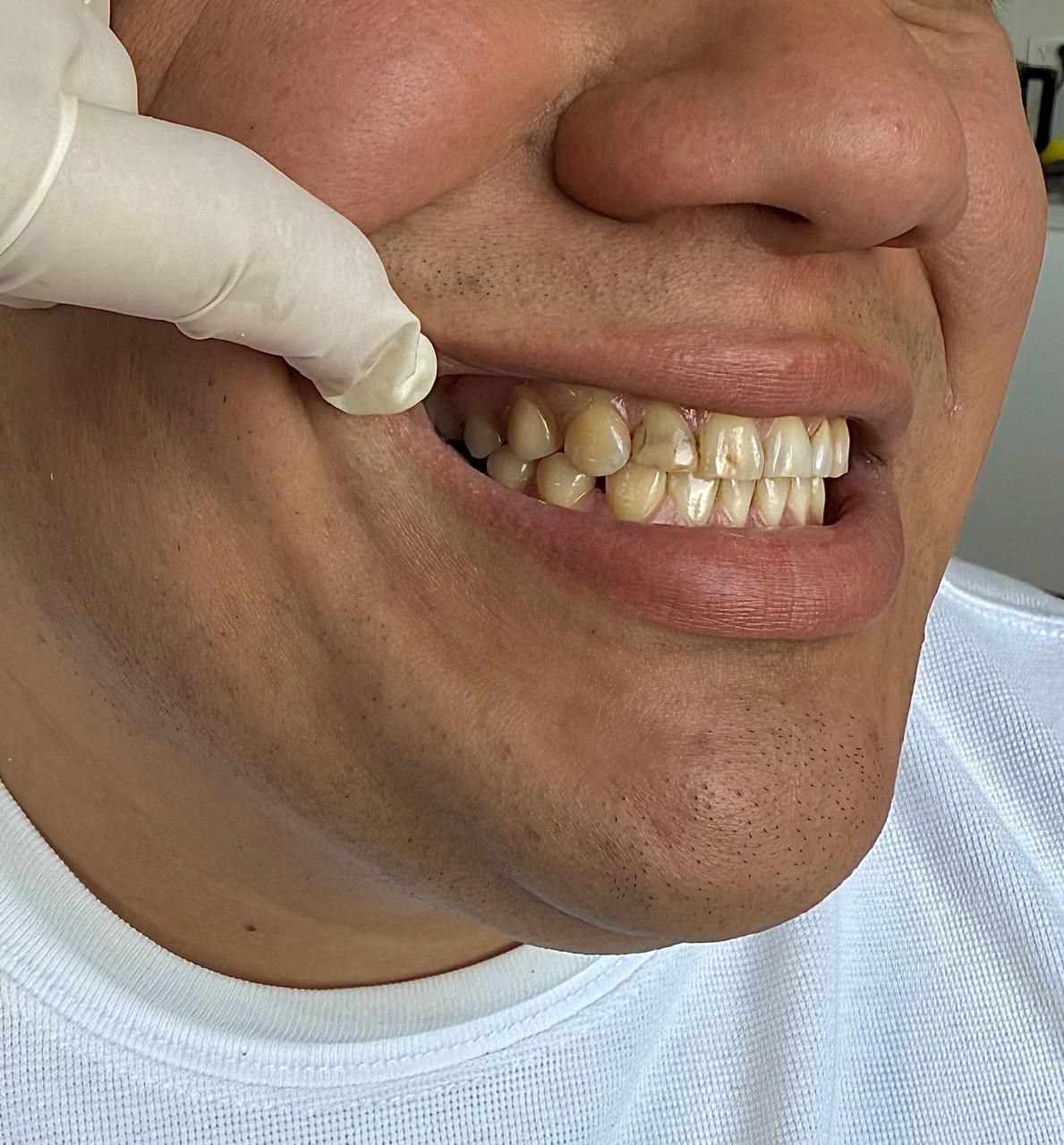 Se están examinando los dientes de una persona con una mano enguantada. Los dientes parecen estar descoloridos.