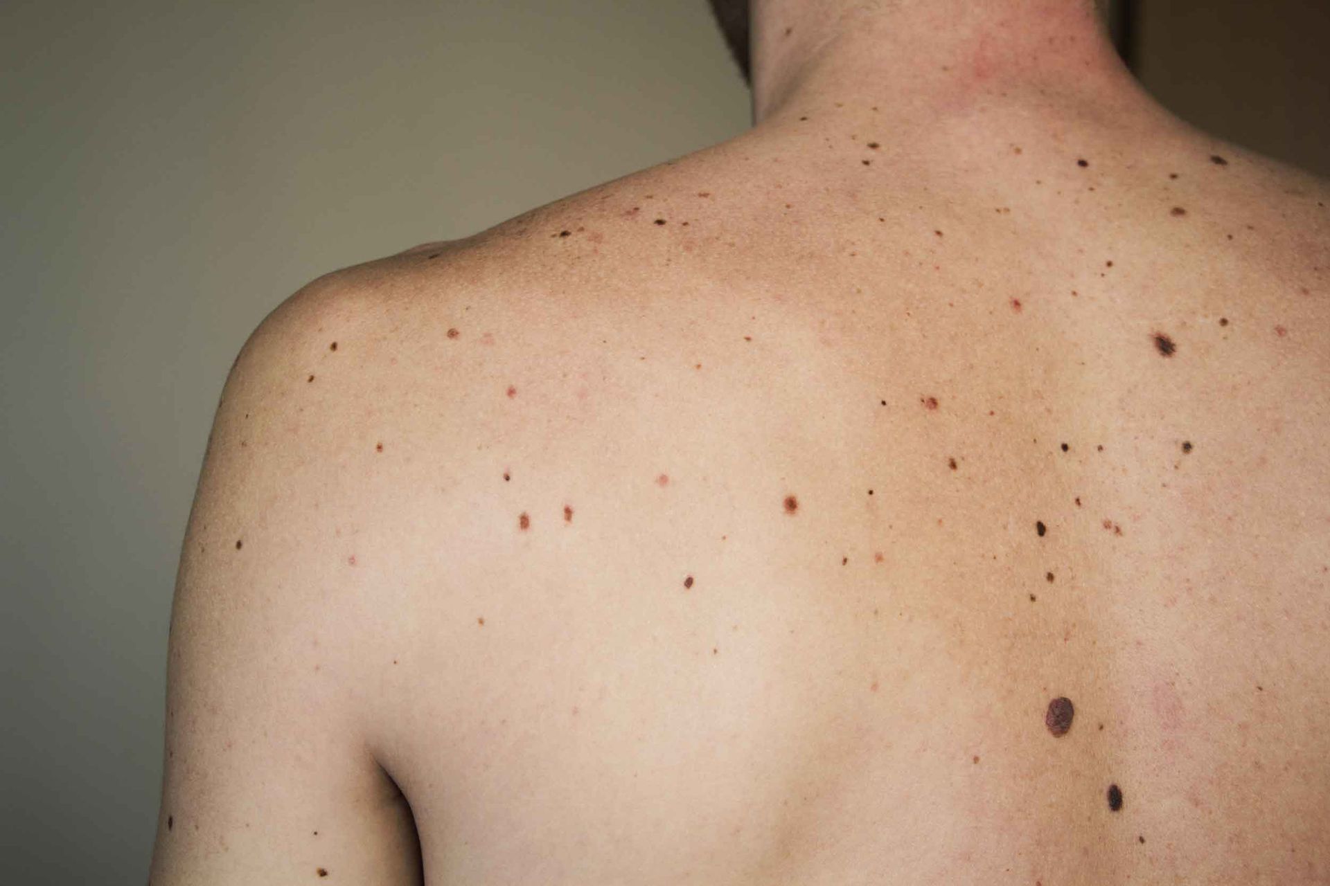 A partial view of a shirtless man’s back covered in moles and body marks.