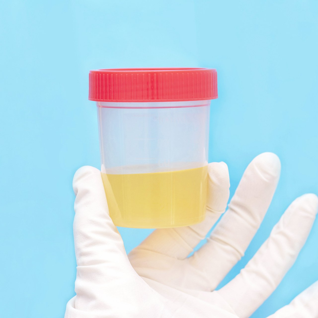 Tratamento para infecção urinária em Brasília Tratamento para infecção urinária recorrente em Brasília