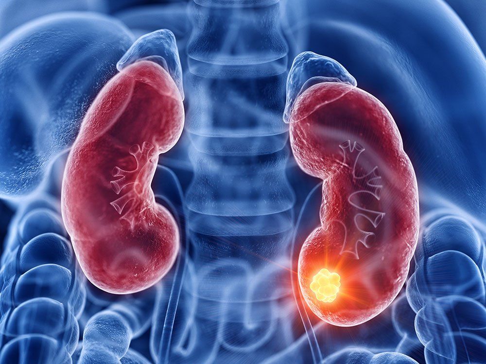 Tumor no rim cresce rápido Tumor no rim cresce rápido