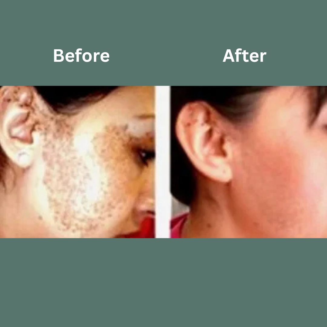 Before-and-after close-up of facial skin, showing reduced acne and clearer complexion.