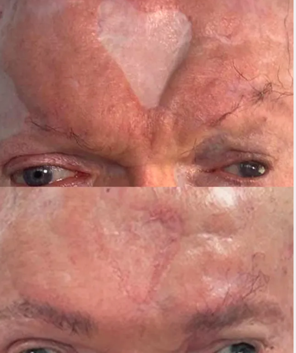 Close-up of a forehead with a white heart-shaped patch and faint red, irritated skin