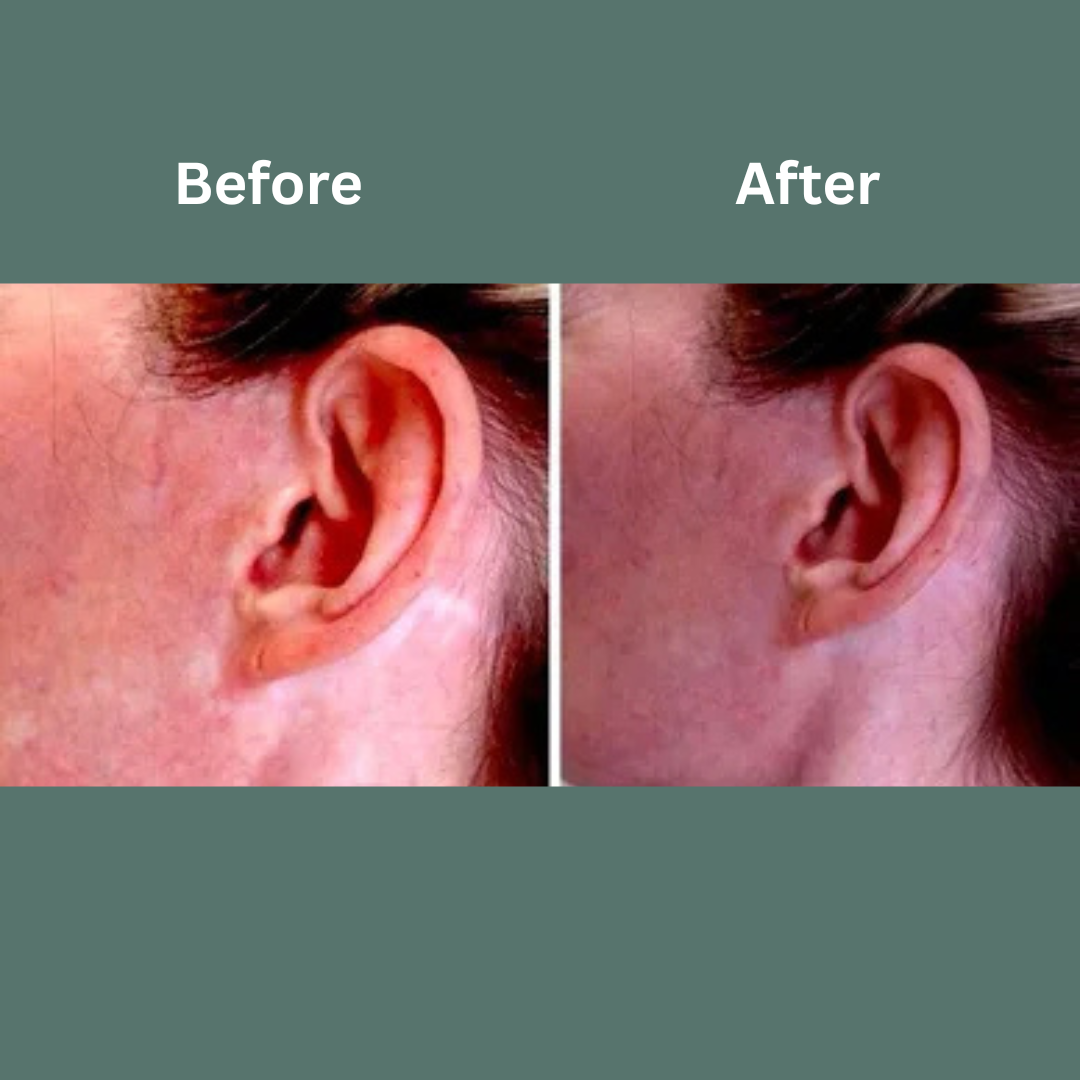 Before-and-after close-up of an ear, showing reduced redness and swelling after treatment.