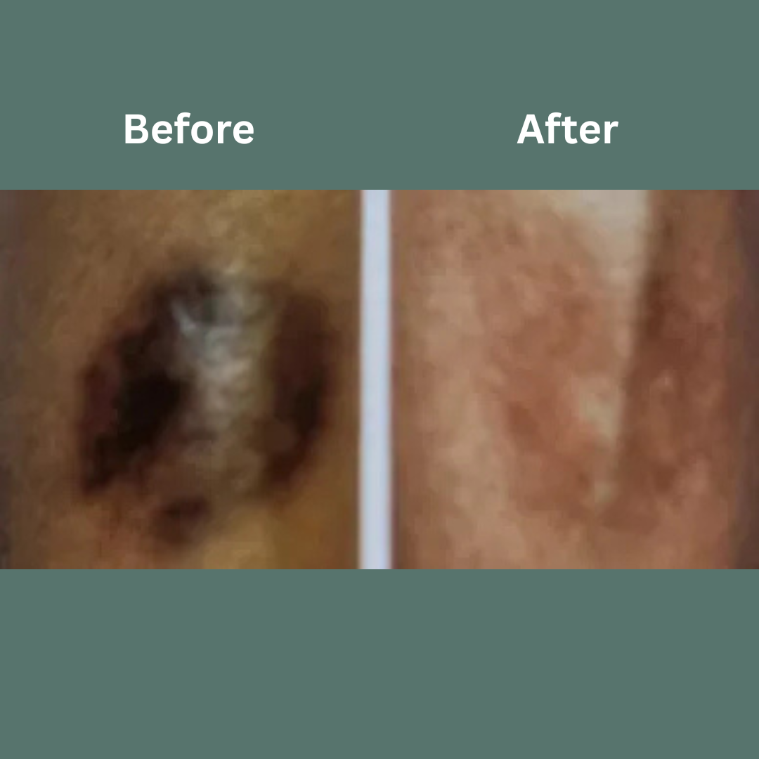 Before-and-after close-up of skin, showing a dark spot fading to lighter, clearer skin.