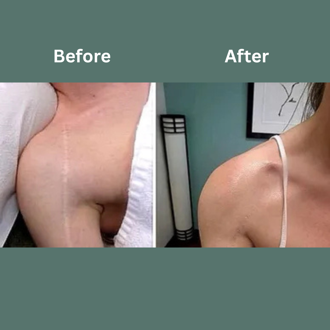 Before-and-after side-by-side of a shoulder/upper chest, with smoother skin and reduced redness after.