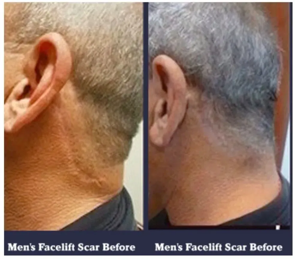 Before-and-after side-by-side of a shoulder/upper chest, with smoother skin and reduced redness after.