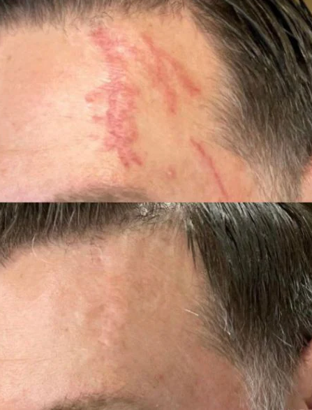 Forehead with a red, healing abrasion shown before and after treatment