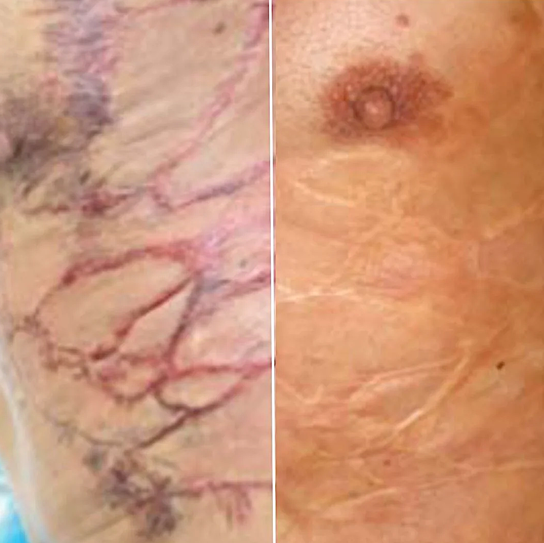 Close-up split image of skin with visible veins on the left and a nipple on the right.