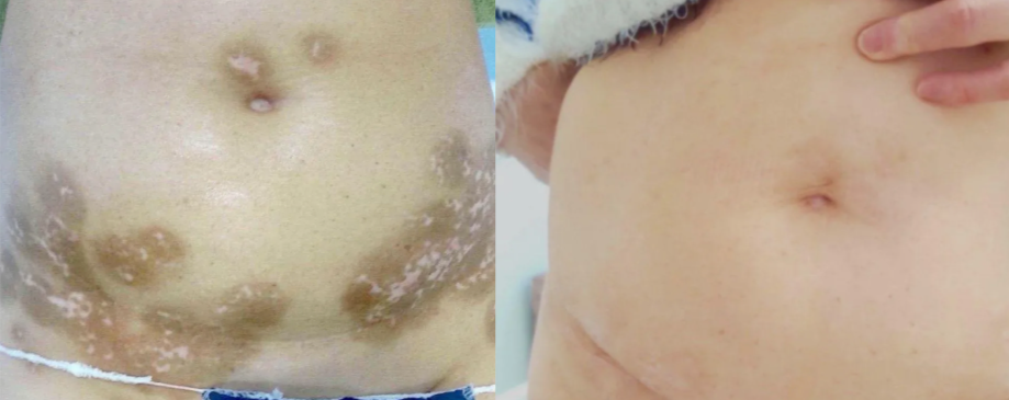 Before-and-after close-up of an ear, showing reduced redness and swelling after treatment.