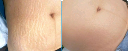 Before-and-after close-up of facial skin, showing reduced acne and clearer complexion.