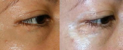 Before-and-after close-up of skin, showing a dark spot fading to lighter, clearer skin.
