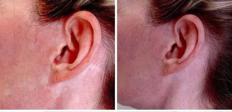 Side-by-side close-up of a person's ear and cheek, showing a red irritated rash before and after treatment.