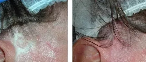 Close-up split image of a reddened scalp with flaky skin and thinning hair near the hairline